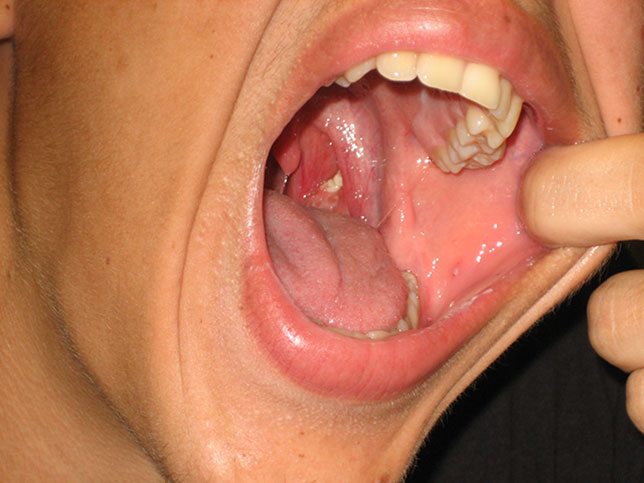 how to remove tonsil stones you cant see