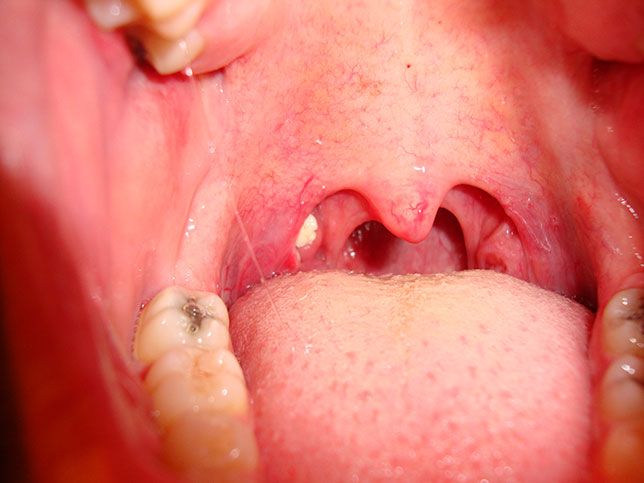 how to remove tonsil stones you can't see