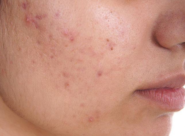 castor oil for acne