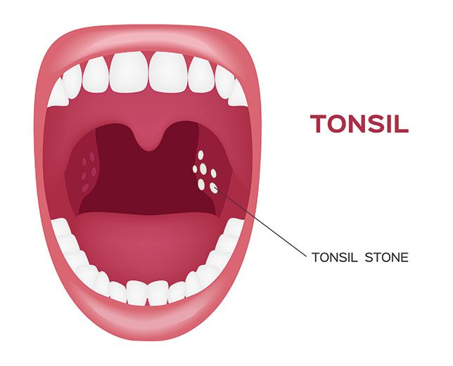 Tonsil stones how to remove