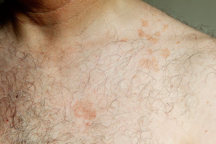 is tinea versicolor caused by diet?