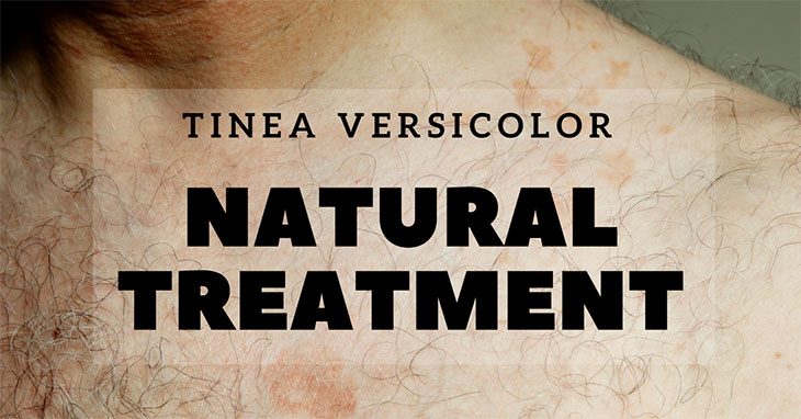 tinea versicolor natural treatment