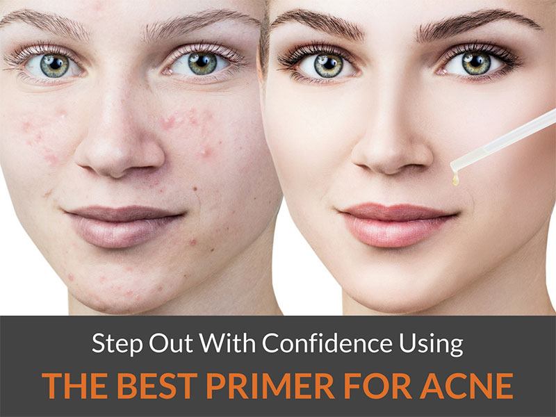best primer for acne