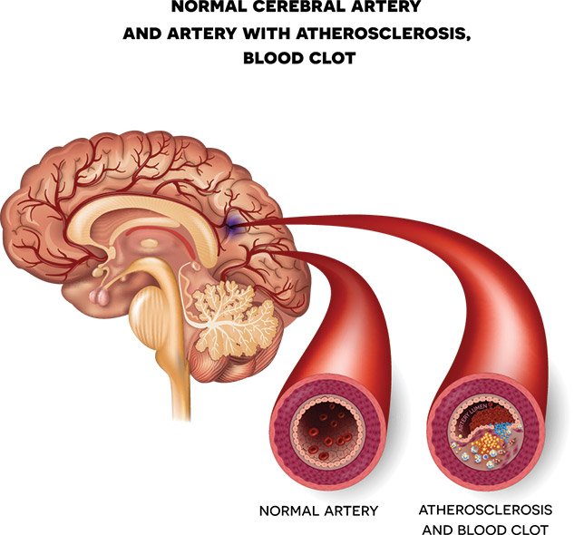 atherosclerosis definition