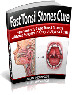 Fast Tonsil Stones Cure by Allen Thompson